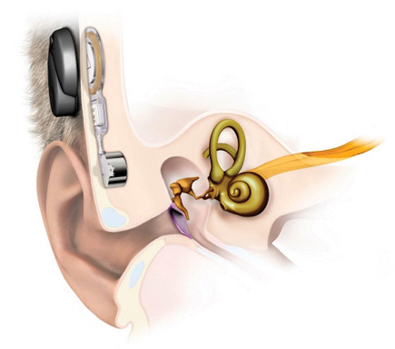 UCL-BHT-Hearing-Implant1-04